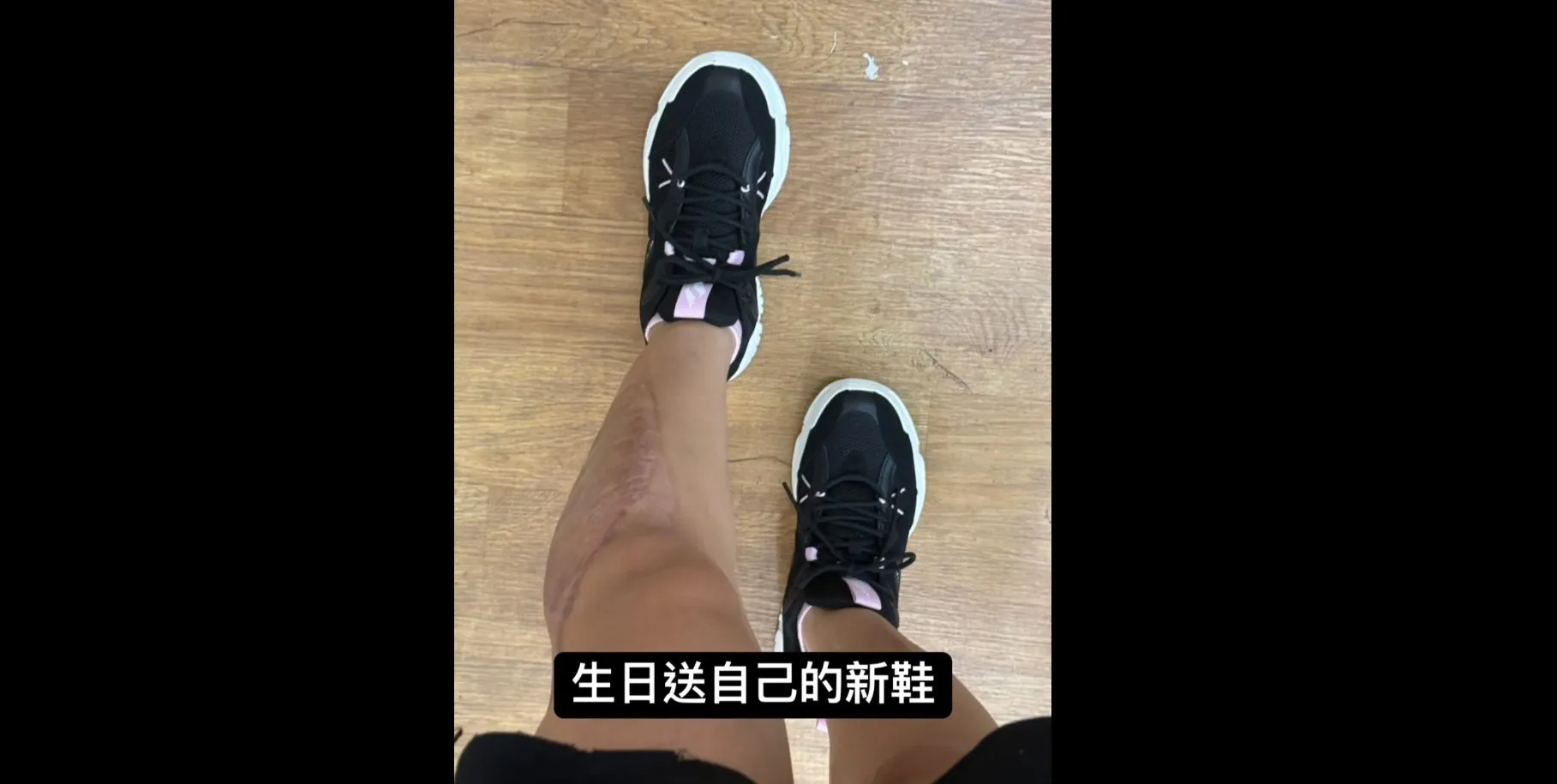 婉晴車禍的疤痕（截取自婉晴ig限動）